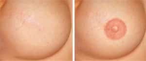 Micropigmentação de Aréola