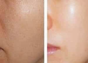 rejuvenescimento facial com mesoterapia