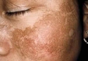 melasma microagulhamento